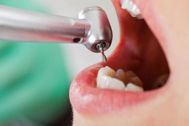 Best Emergency Root Canal Treatment in Crooksville, OH
